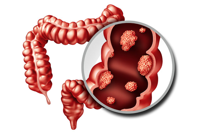 Colorectal Cancer Screening Age Lowered to 45 | VCU Massey Comprehensive  Cancer Center