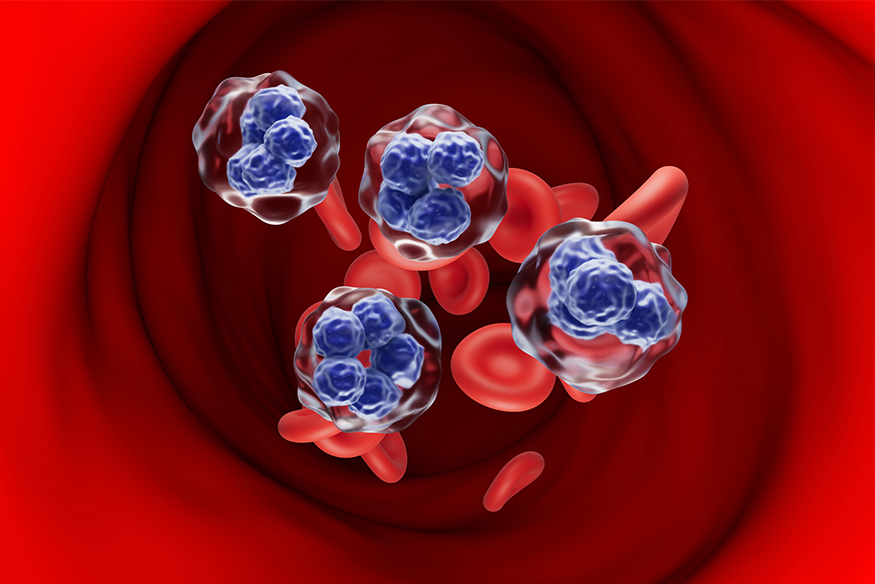 A conceptual 3D illustration of several large, abnormal lymphoma cells (cancerous white blood cells) with multi-lobed, blue nuclei circulating among smaller, red blood cells within a vessel.