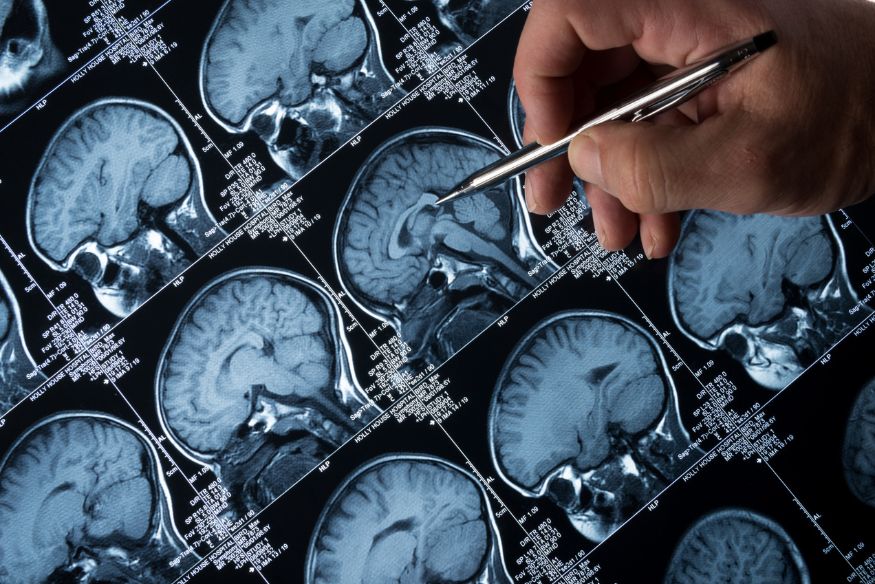 Doctor reviewing scans of brain tumors