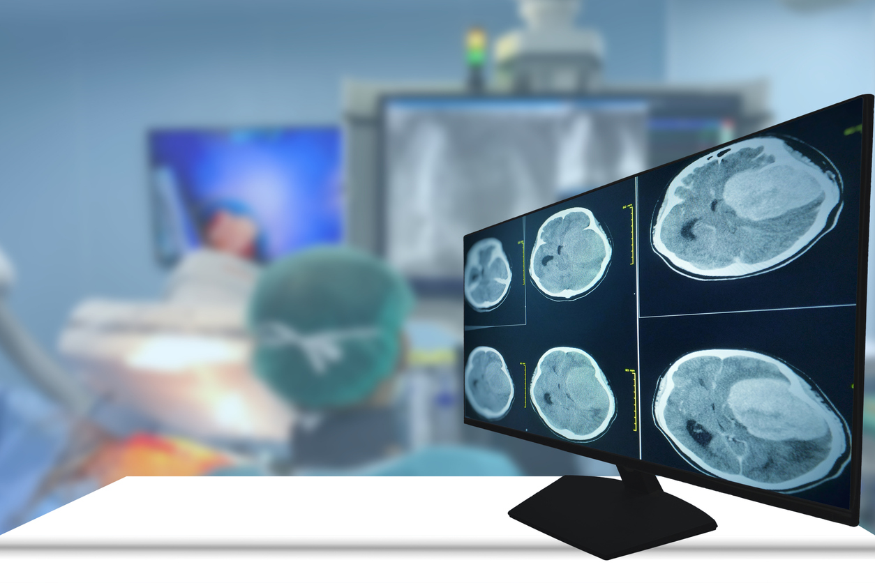 A computer monitor in an operating room displaying brain CT scans that show a large glioblastoma tumor, with surgical staff blurred in the background.