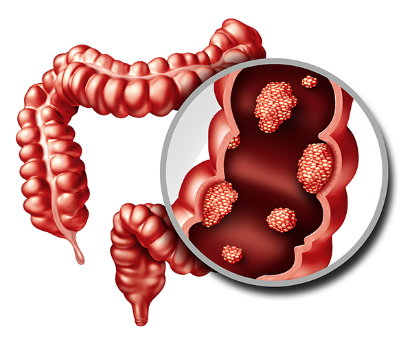 Colon Cancer