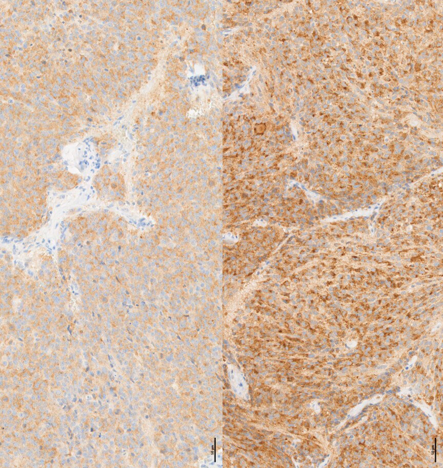Neuroblastoma ferroptosis