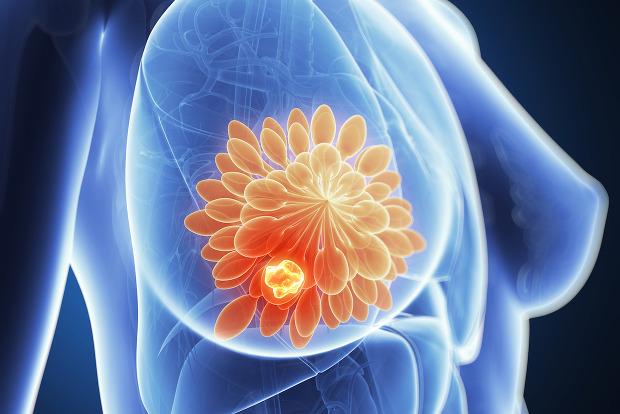breastCancer