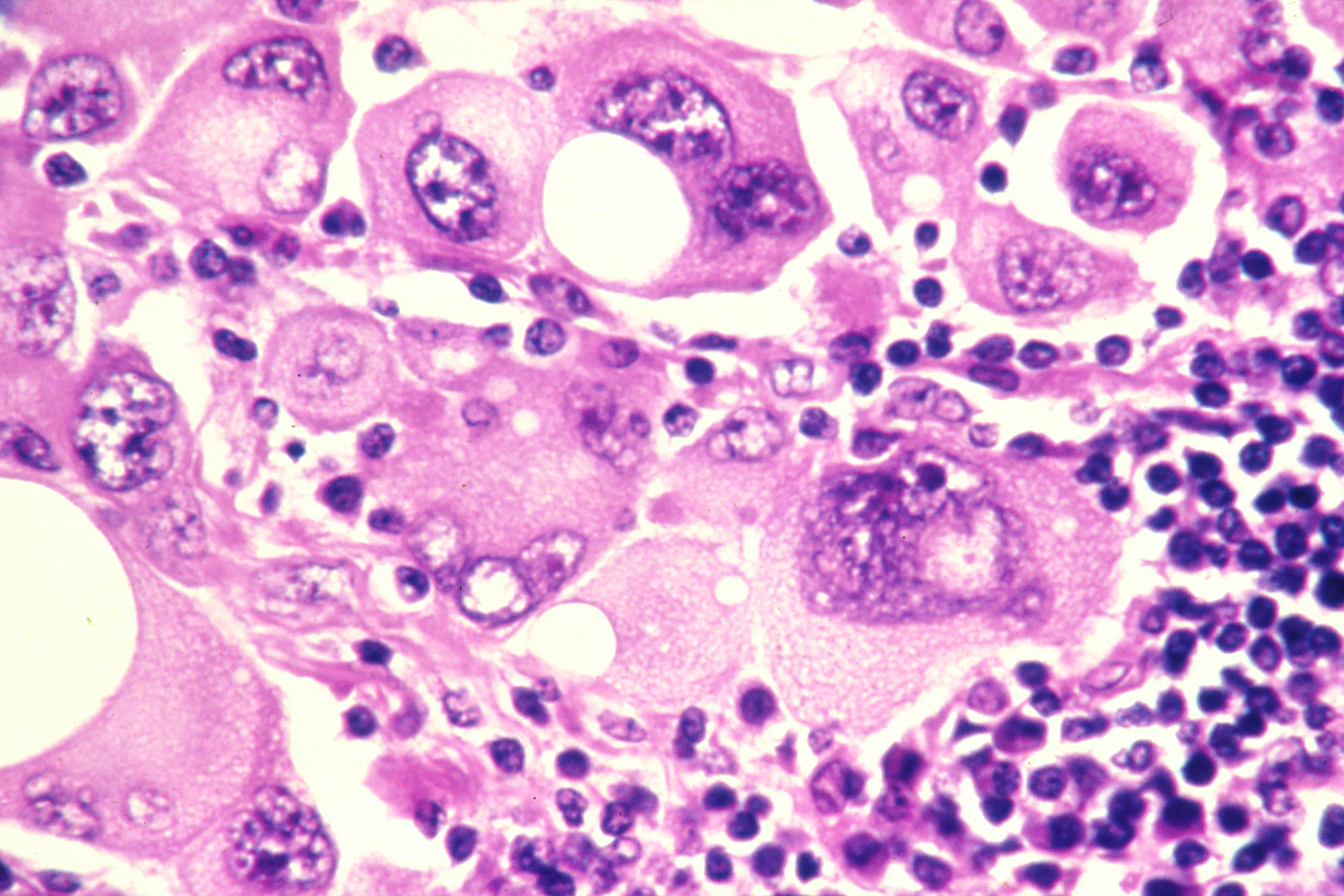 melanomacancercell