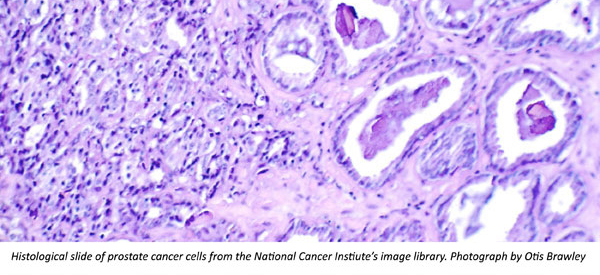 nci-prostate-cells-Otis-Brawley-600x275